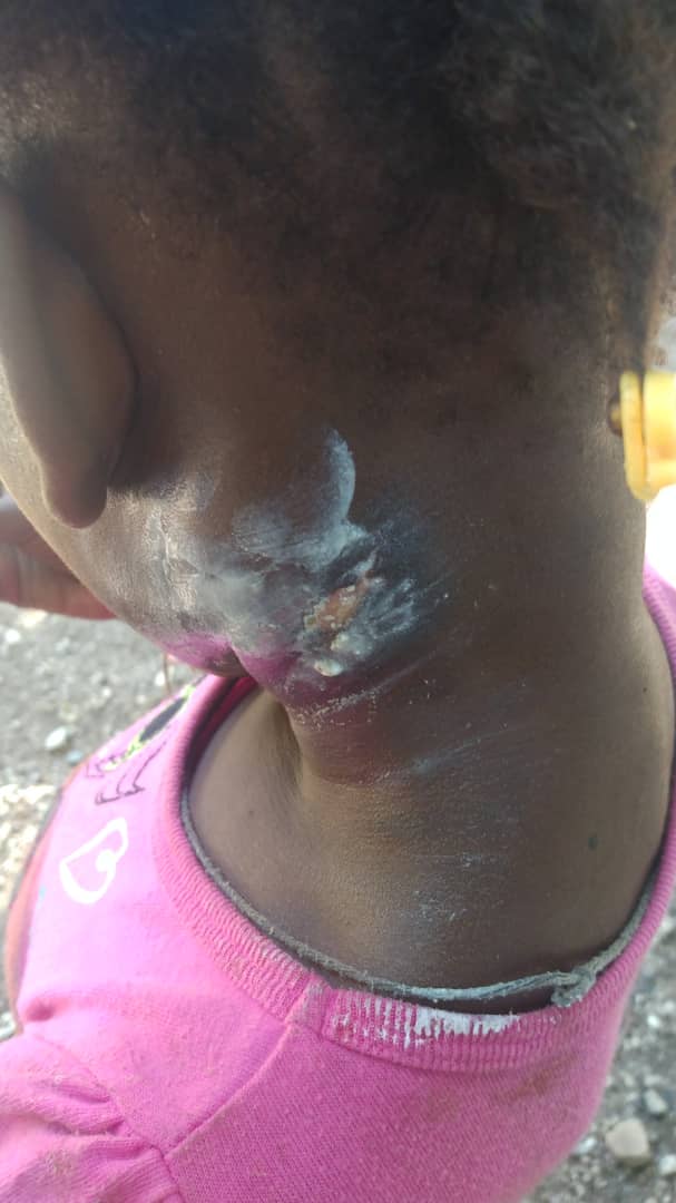 Child Outdoors Receiving Care